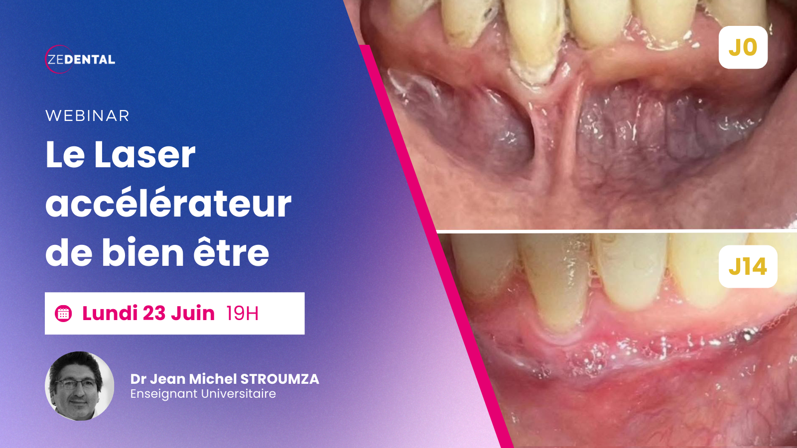 20250623 l Zedental l Conf | Laser accélérateur de bien-être - Dr Stroumza l Cover